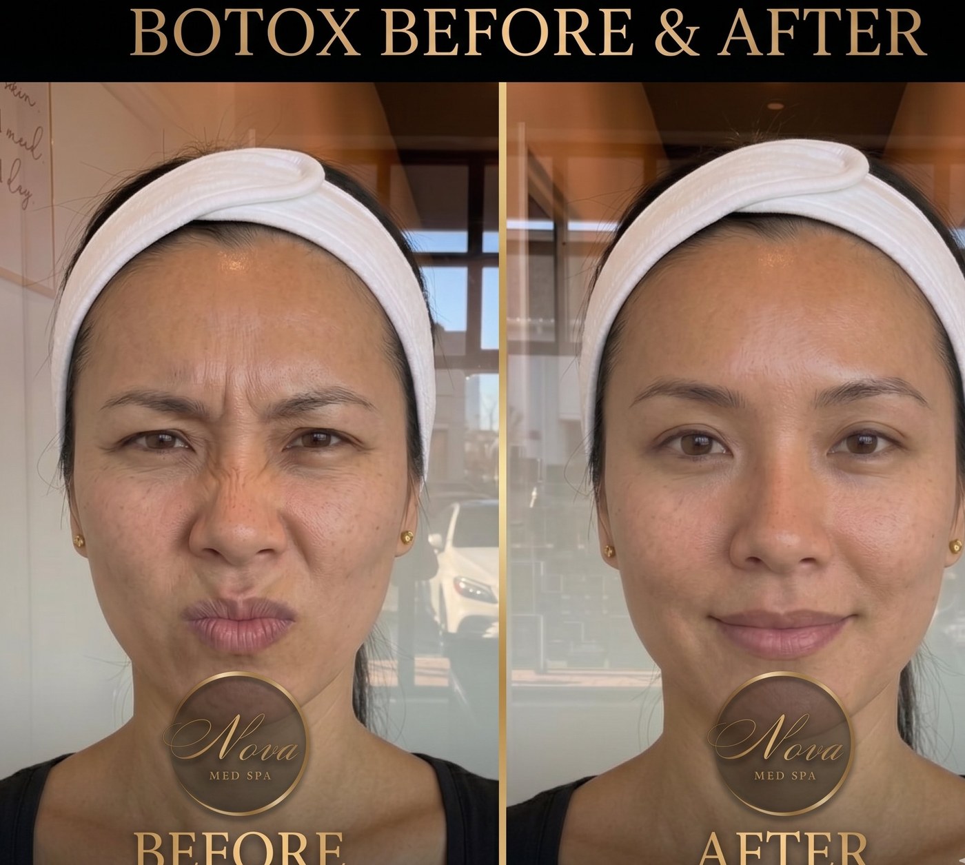 Botox before and after - frown lines smoothed at Nova Med Spa