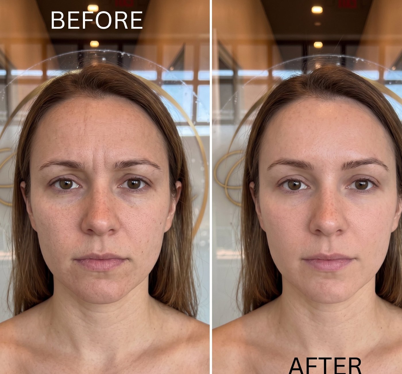 Botox before and after - forehead lines at Nova Med Spa