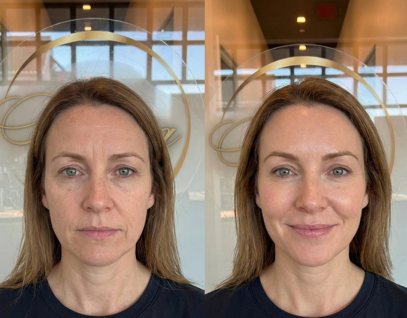 Botox before and after - complete refresh at Nova Med Spa