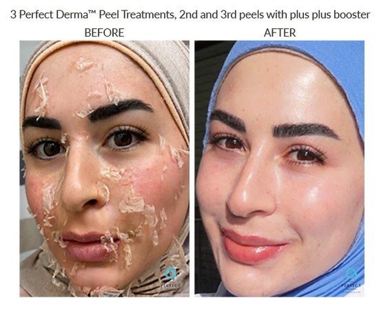Chemical Peel Before and After at Nova Med Spa Plainview NY