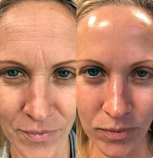 Hydra Treatment Before and After - texture & glow - Nova Med Spa Plainview NY