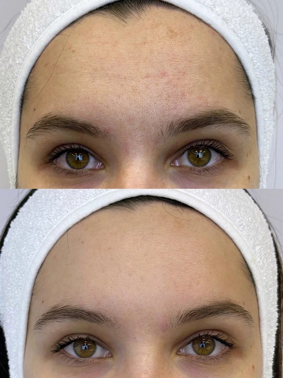 Morpheus8 skin texture renewal