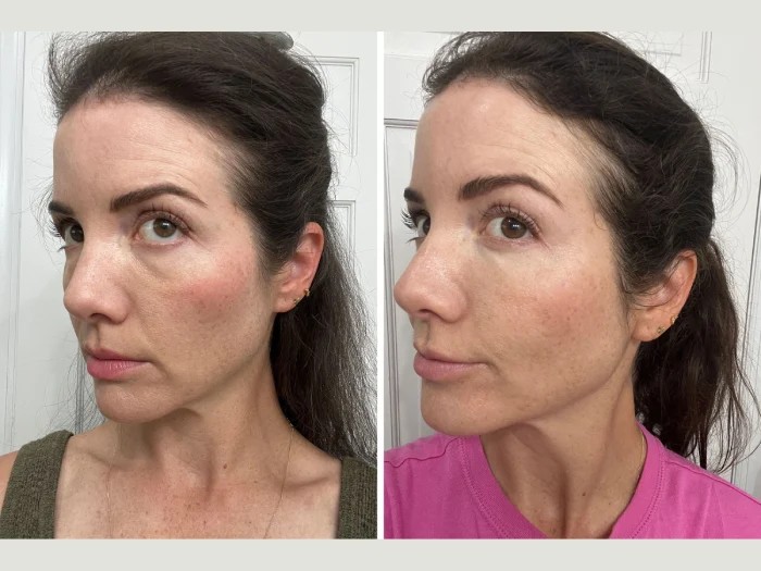 Morpheus8 + PRP combination treatment