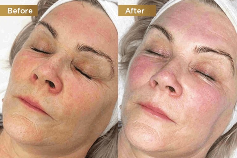 Red Carpet Glow Facial Before and After - hydration & complexion - Nova Med Spa Plainview NY