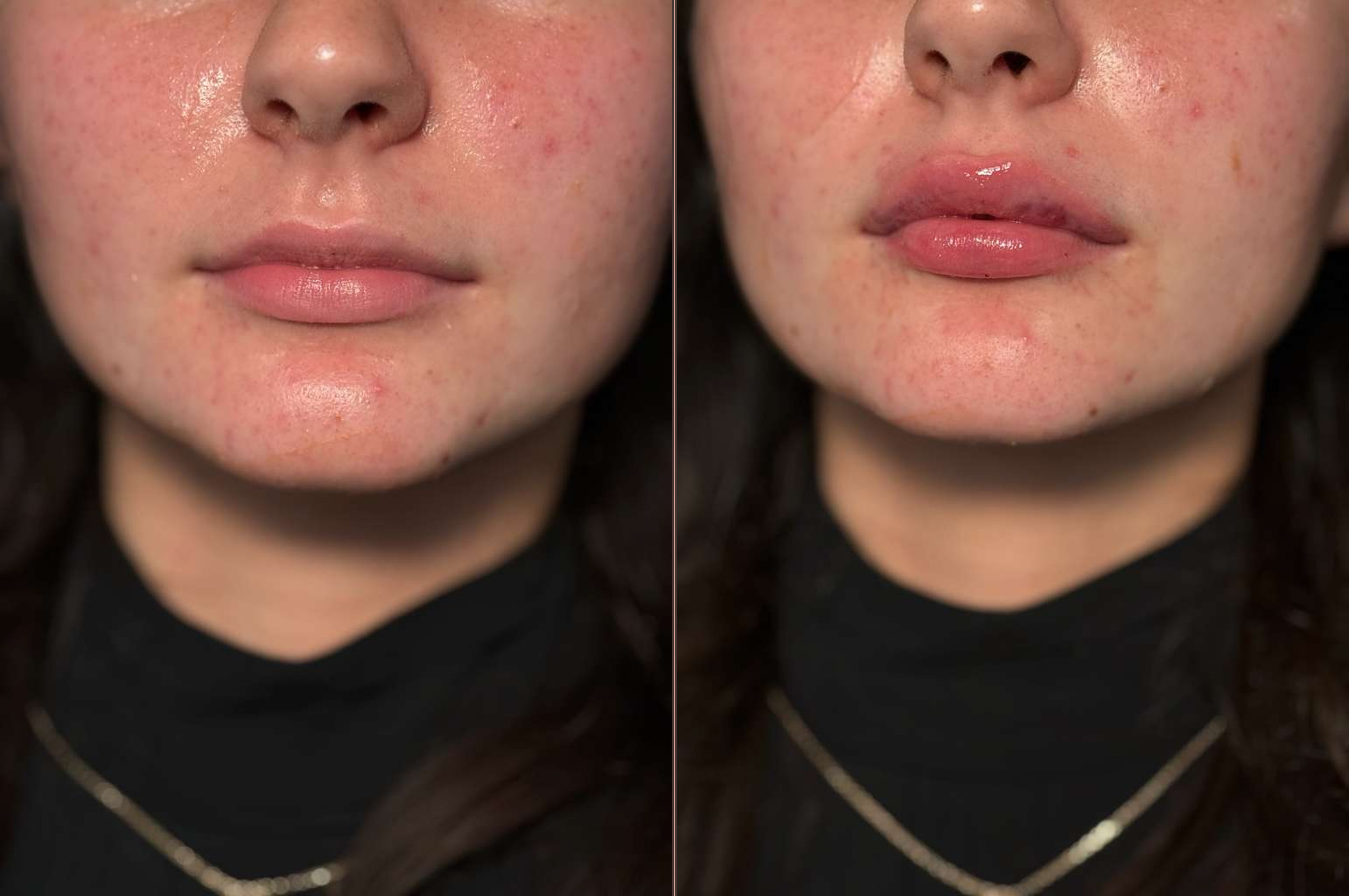 Lip filler before and after - real Nova client