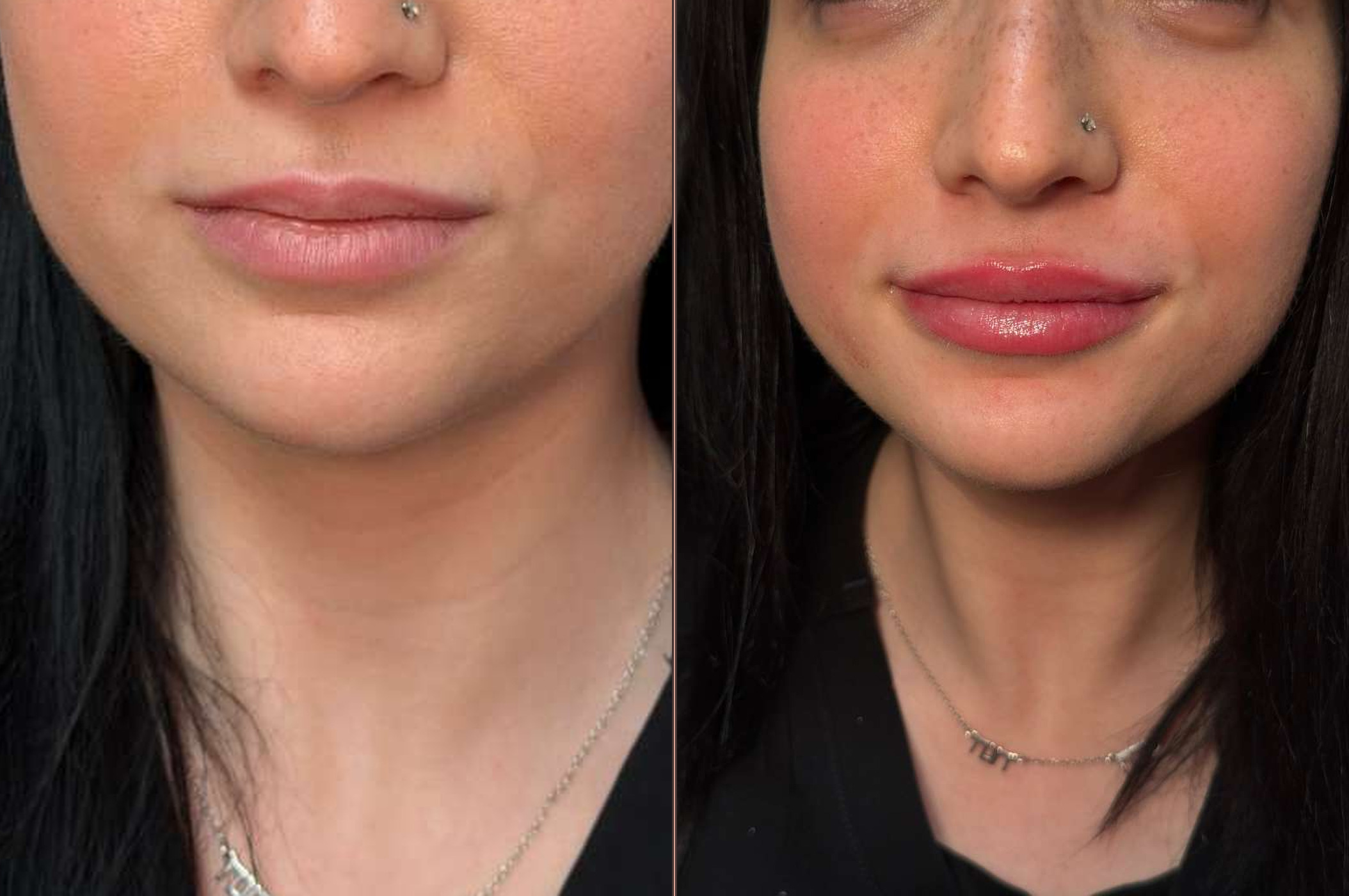 Lip filler before and after - Nova client