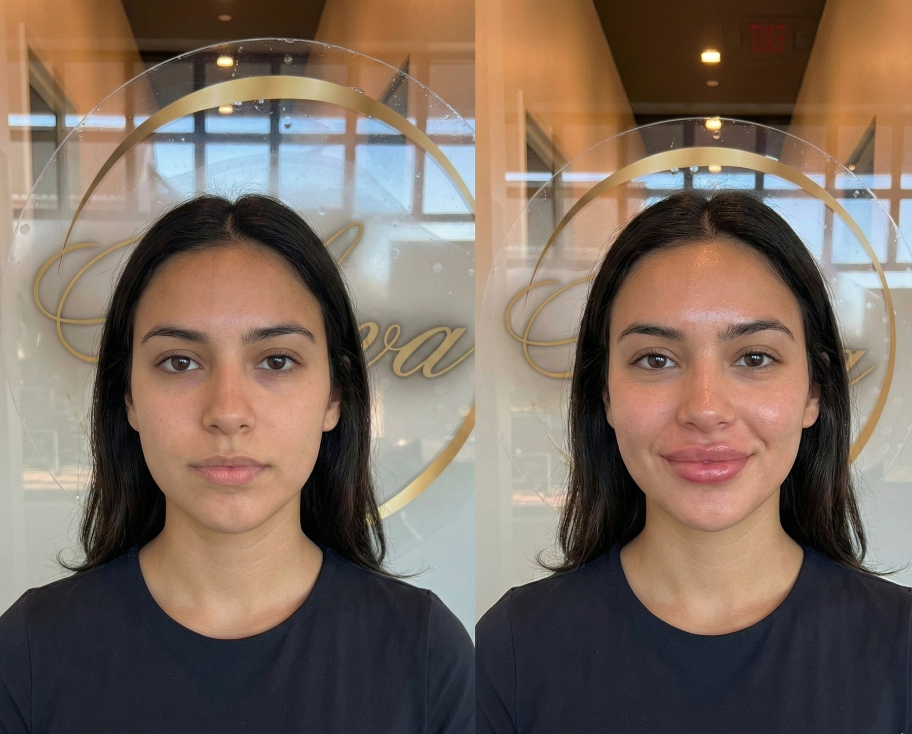 Lip filler before and after - featured result