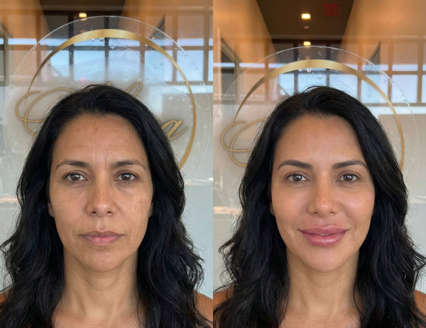 Lip filler rejuvenation result