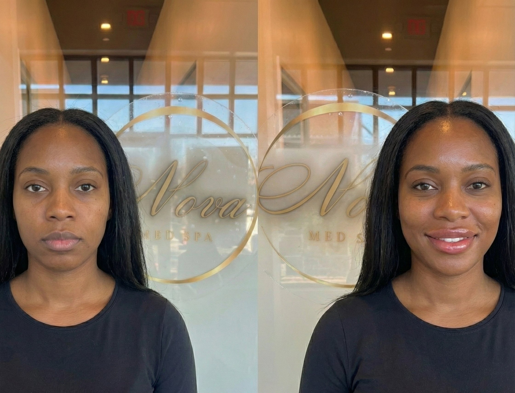 Natural lip filler result