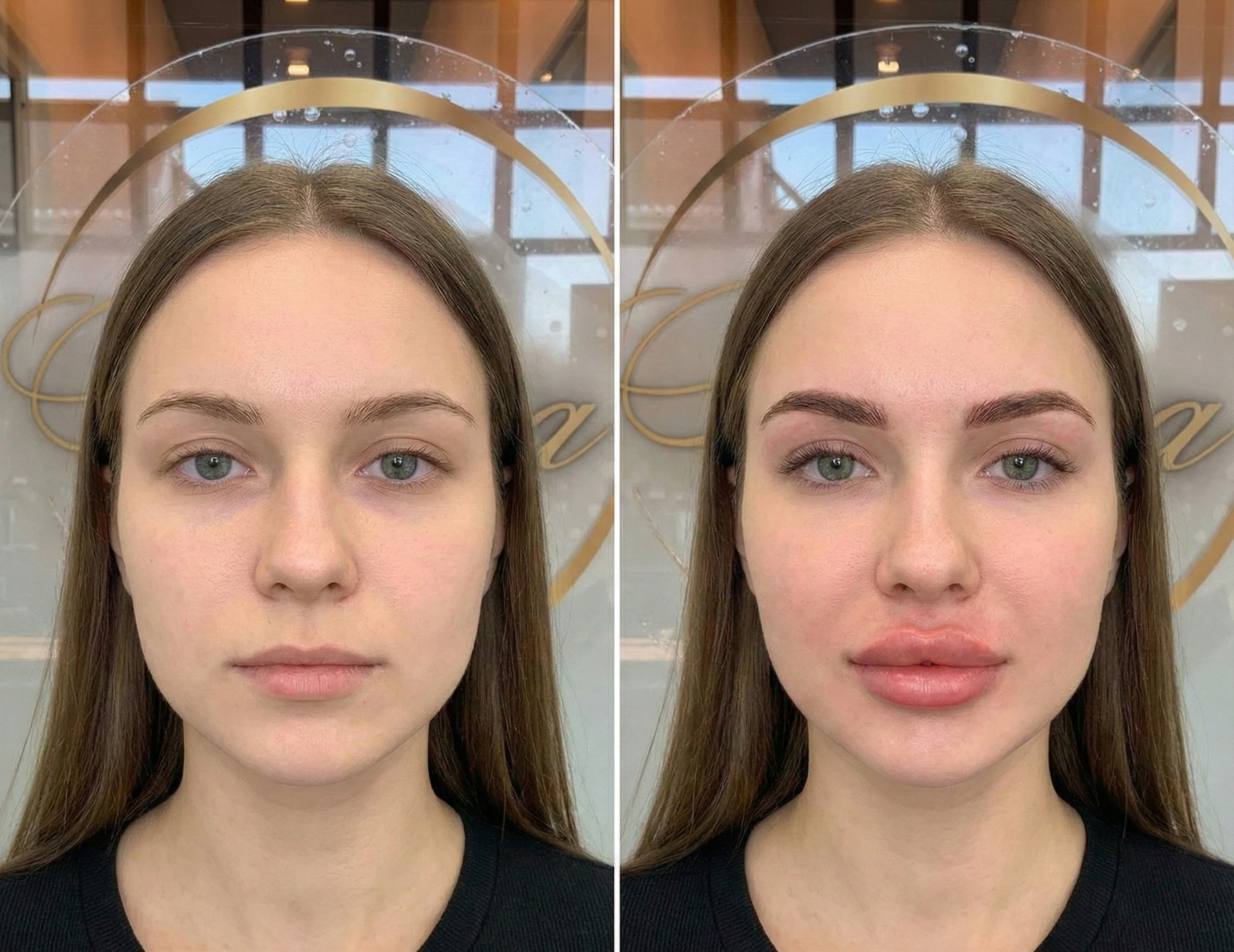 Russian lift lip filler result