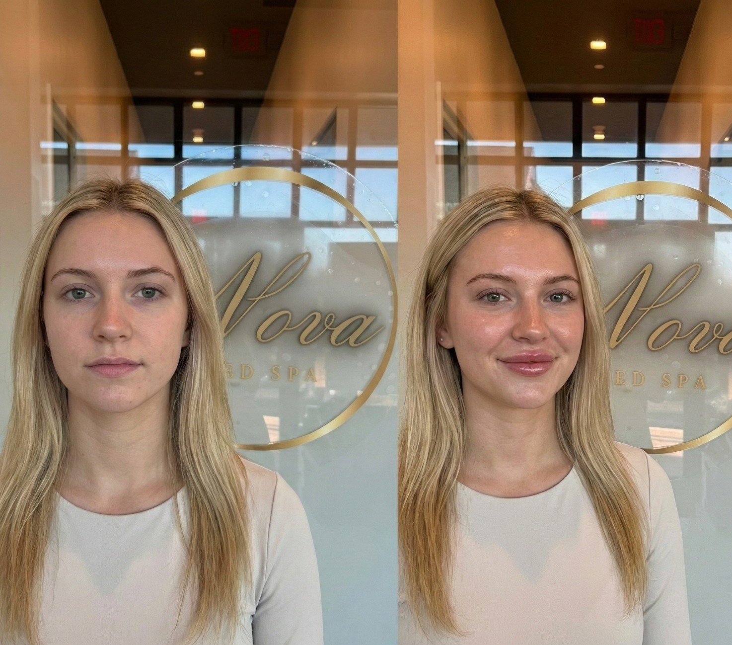 Subtle lip filler enhancement