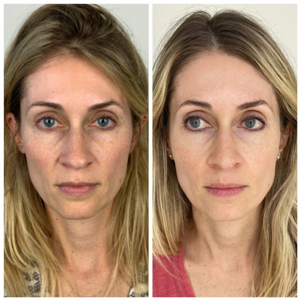 Morpheus8 face + neck result